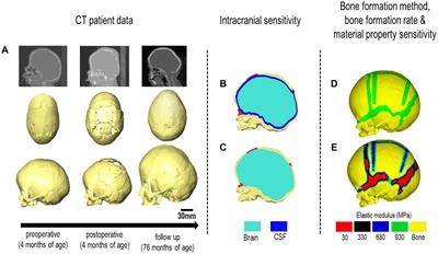 Using Sensitivity Analysis to Develop a Validated Computational Model of Post-operative Calvarial Growth in Sagittal Craniosynostosis